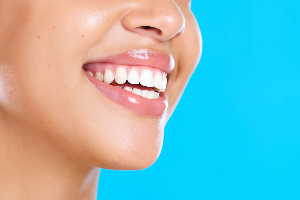 Ceramic Fillings Dubai | Inlays & Onlays by Dr Vesna