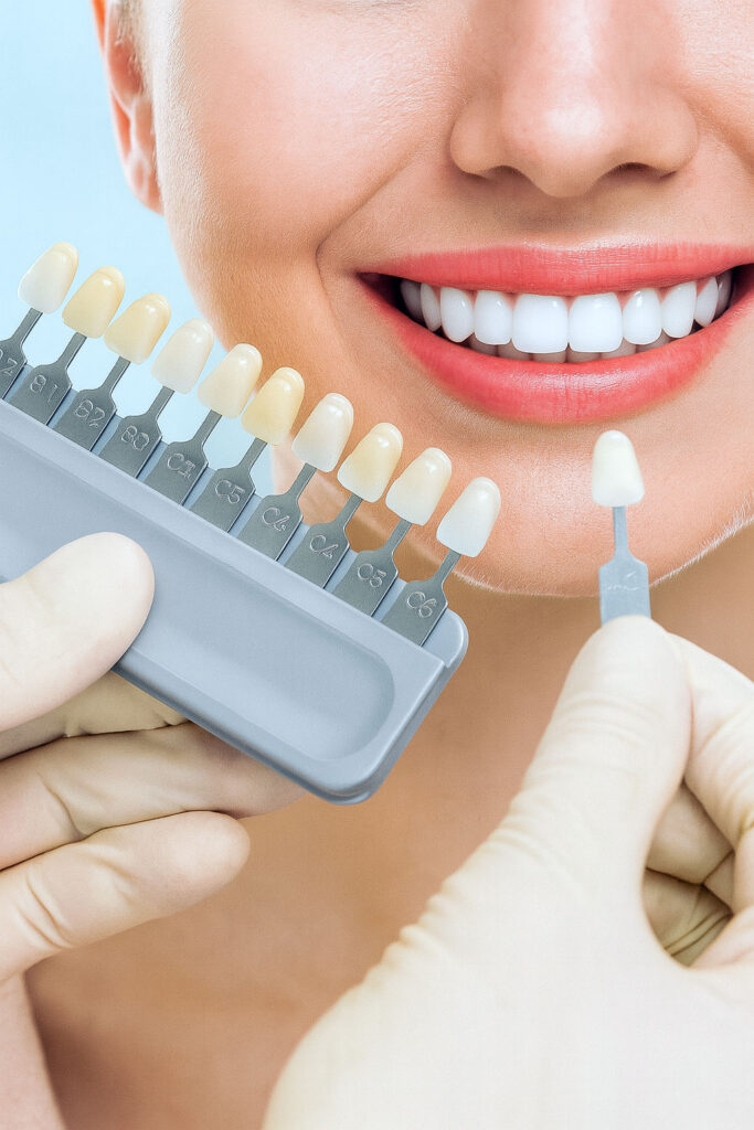 Composite Veneers Dubai | Affordable Smile Makeover