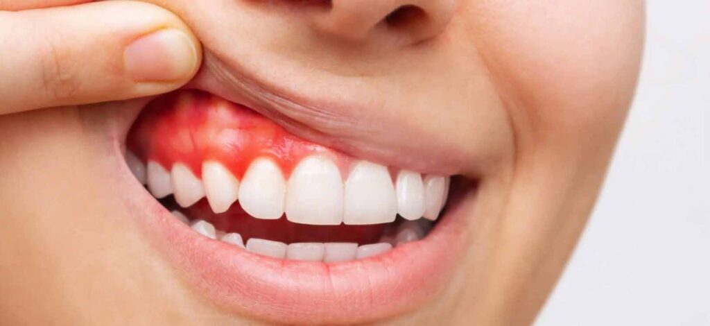 Gum Disease Treatment Dubai | Restore Healthy Gums